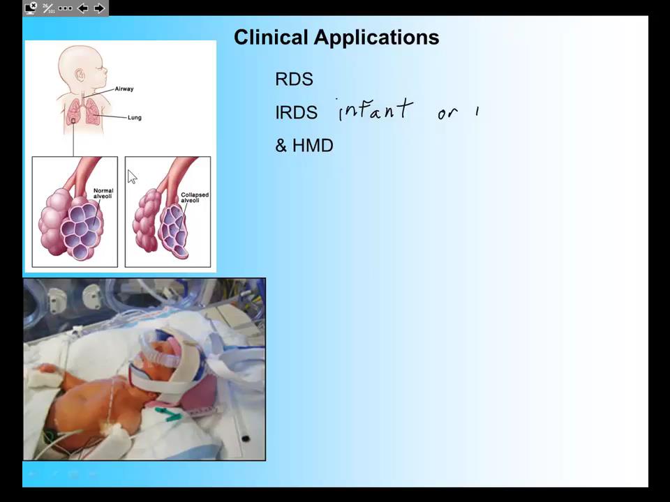 case study respiratory distress syndrome newborn